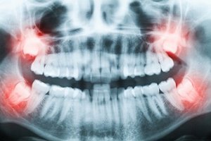 5 Things You Didn’t Know About Your Wisdom Teeth