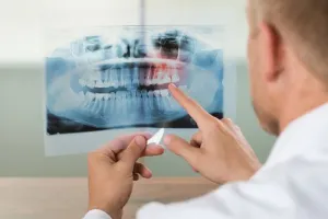 How Safe Are Bone Grafts?