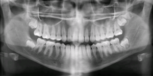 Panoramic X-ray – Why you need one
