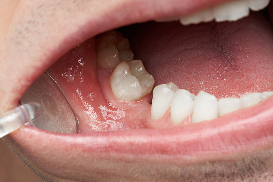 4 Long-term Consequences of Missing Teeth