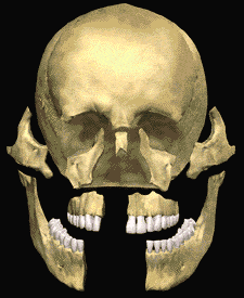 Animated image of how facial bones can fracture