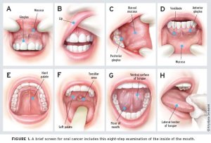 Illustrated chart: 8 ways to perfom an oral cancer self exam